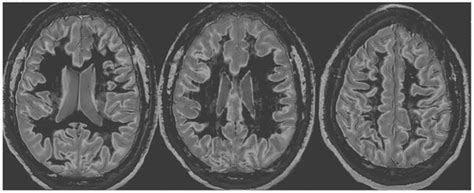 Diagnosis of Delayed Post-Hypoxic Leukoencephalopathy (Grinker’s ...