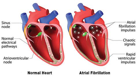 Atrial Fibrillation 的图像结果