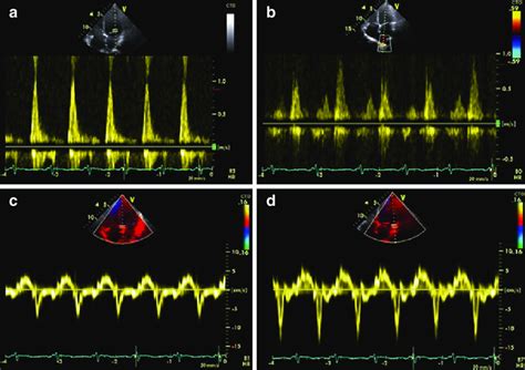 Image result for Moderate Diastolic Dysfunction
