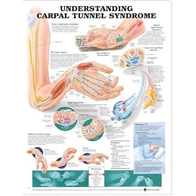 Buy Understanding Carpal Tunnel Syndrome Anatomical Chart Online at ...