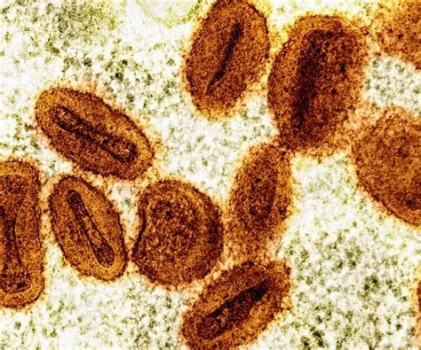 US Health Officials Report 1st Case of New Form of Mpox in a Traveler ...