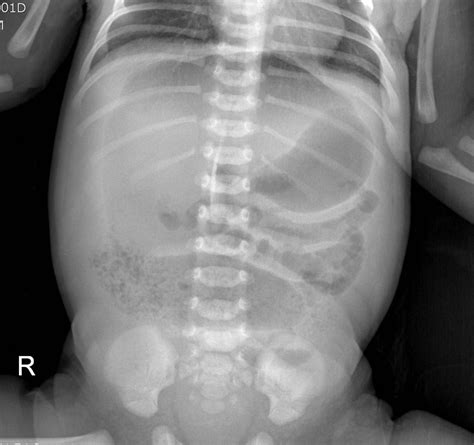Plain radiograph in a neonate with abdominal distension | The BMJ