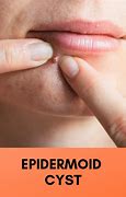 Image result for Epidermoid Cyst Home Remedies