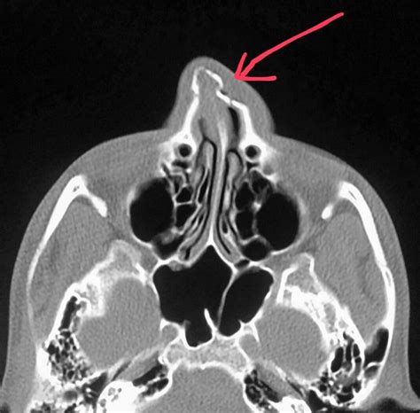 #Head #CT shows severe #sinusitis with the sinuses completely blocked ...