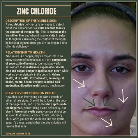 homeopathic zinc met 30c