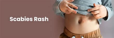 Scabies Rash: Symptoms, Causes, Treatment, & Prevention