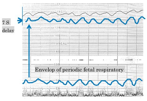 Algorithms for Computerized Fetal Heart Rate Diagnosis with Direct ...