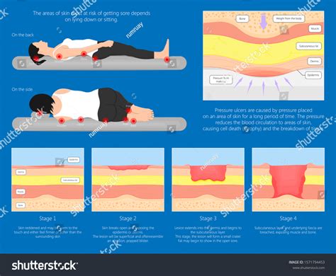 1,459 Pressure Ulcer Images, Stock Photos & Vectors | Shutterstock