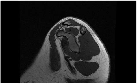 Atraumatic Acromioclavicular Joint Dislocation: A Case Report Treated ...