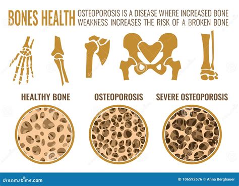 Does Osteoporosis Affect Your Teeth