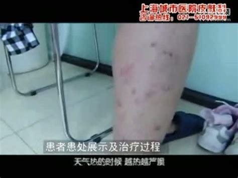 脸上怎么会生湿疹-上海城市医院皮肤科-健康视频-搜狐视频