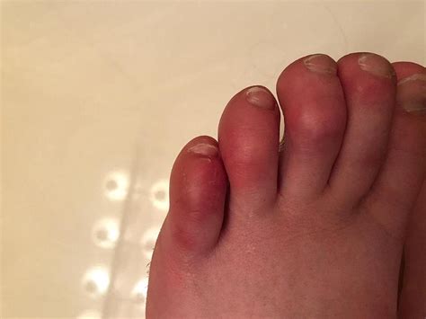 A new symptom of infection in children is swelling of the toes ...