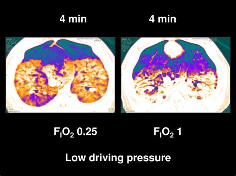 Image result for FiO2 2 LNC