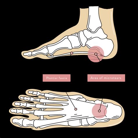 Plantar Fasciitis 的图像结果