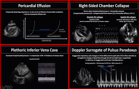 Pericardial Effusion Echo
