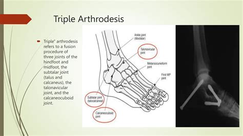 Ankle Arthrodesis.pptx