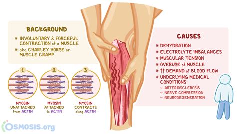 Muscle Spasms: What Are They, Causes, Diagnosis, and More | Osmosis