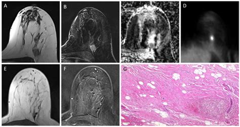 Multiparametric 18F-FDG PET/MRI-Based Radiomics for Prediction of ...