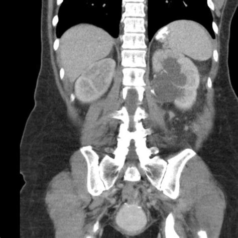 CT Findings in Patients With Pericardial Effusion: Differentiation of ...