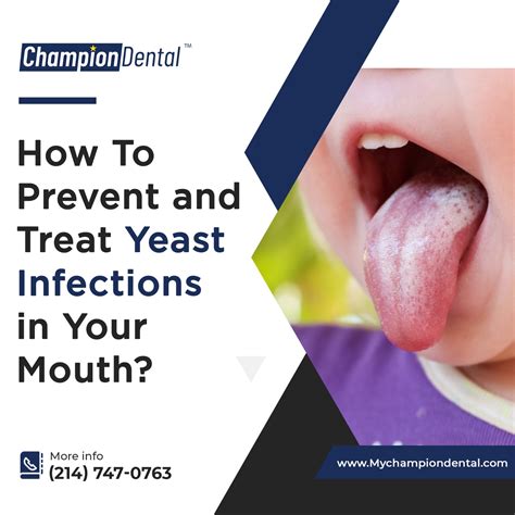 How To Prevent and Treat Yeast Infections in Your Mouth? - Champion Dental