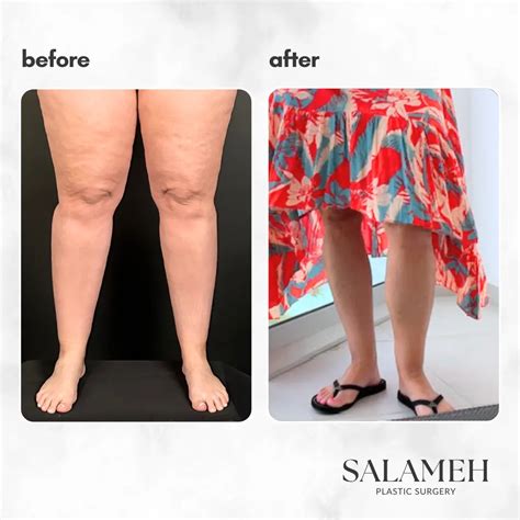 Understanding Lipedema Legs: Causes, Symptoms, and Treatment - Salameh Plastic Surgery Center