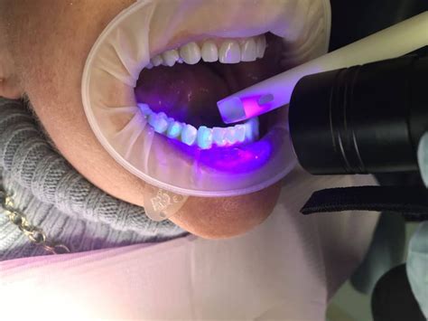 Invisalign Buttons 的图像结果