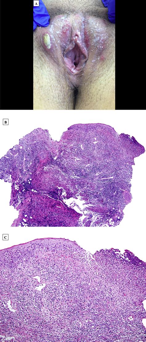 Aphthous vulvar ulcers: a paradoxal adverse effect at distance of ...