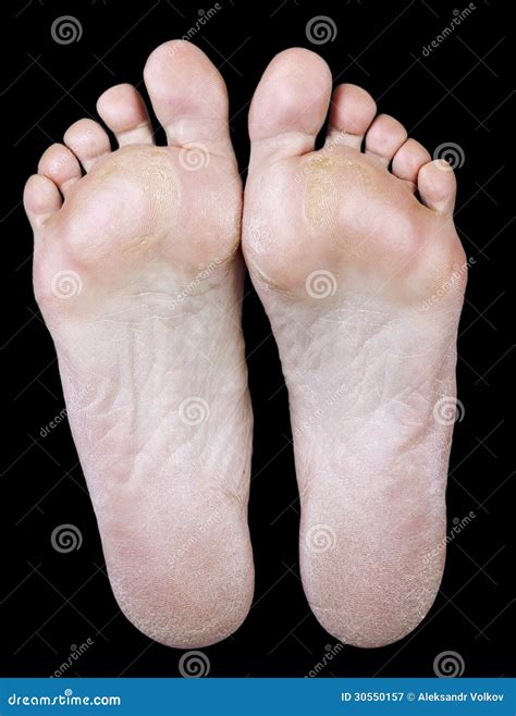 Foot of an Woman with Calluses Stock Image - Image of callosity, underside: 30550157