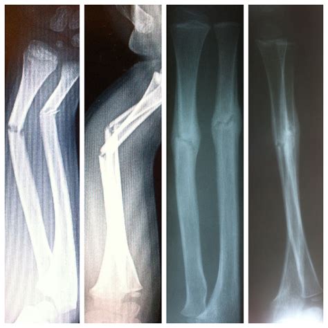 Ulna Bone Fracture
