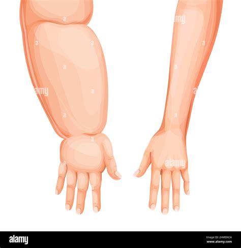 Lymphedema arm Cut Out Stock Images & Pictures - Alamy