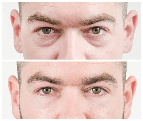 Harpers Bazaar: Everything you need to know about non-surgical eye bag removal - From the Media ...