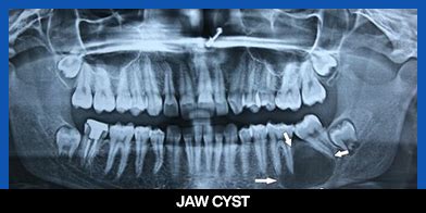 Image result for Exploding Mouth Cyst