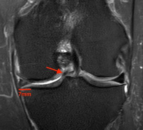 Bucket-handle Tear of the Meniscus - Radsource
