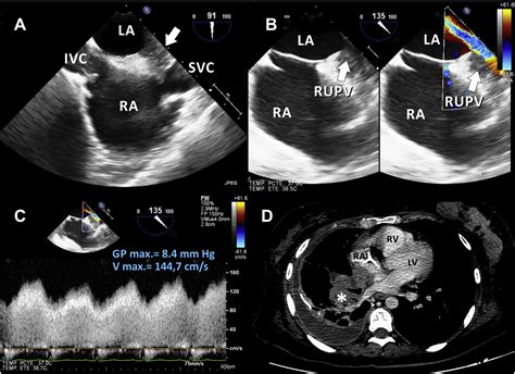 Pulmonary vein stenosis due to invasion of metastatic clear cell ...