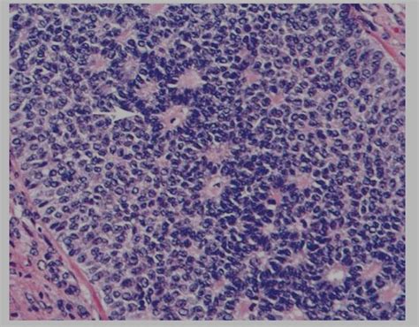 Granulosa cell tumor :: COFFEE BEAN grooved nuclei tendency to arrange ...