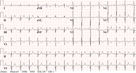 Image result for Normal vs Abnormal ECG