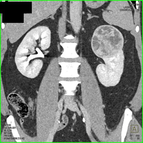 Clear Cell Renal Cell Carcinoma (RCC) with Neovascularity - Kidney ...