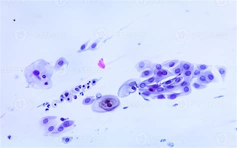 Squamous Metaplastic Cells