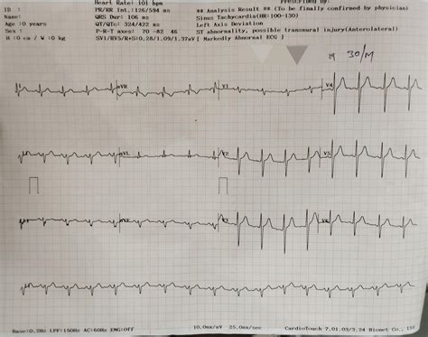 Abnormal Ekg Results