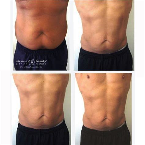 CELLULITE TREATMENT BEFORE & AFTERS - Nirvana Beauty Laser Clinics