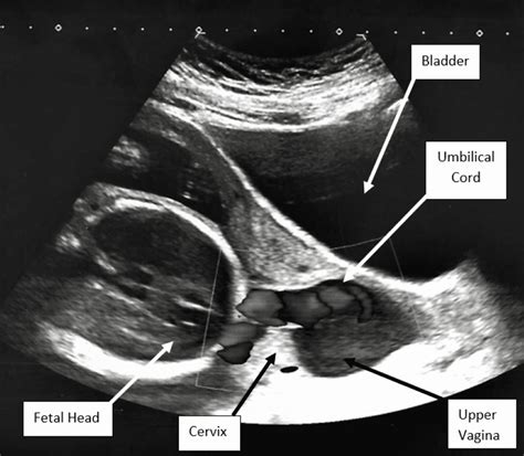 Bildergebnis für umbilical cord ultrasound images