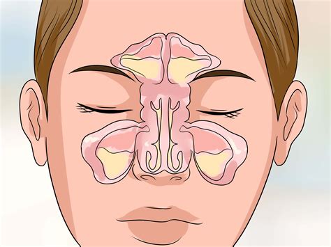 How to Get Rid of a Stuffy Nose Quickly (with Pictures) - wikiHow