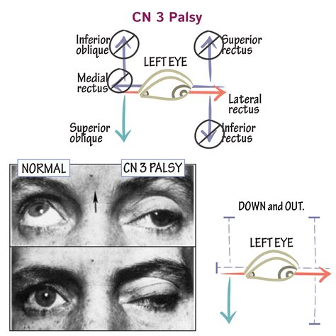 Third Cranial Nerve Damage Repair Understanding The Difference Between