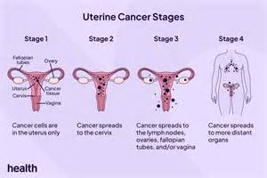 The 4 stages of uterine cancer—and what each one means