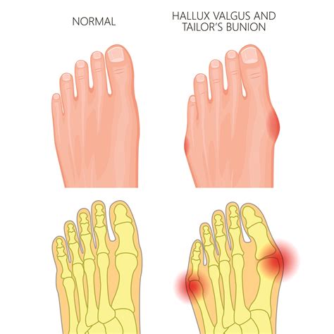 Bunion & Hammertoe Treatment | Brooklyn Foot Doctor — DYKER PARK FOOTCARE, PLLC