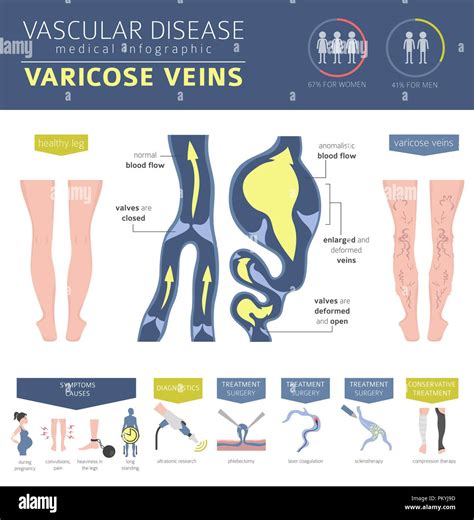 Vascular diseases. Varicose veins symptoms, treatment icon set. Medical infographic design ...