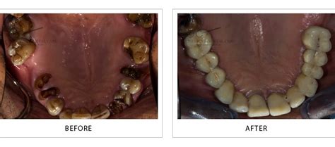 Best Dental Implants HSR Layout | Dental Implants Near Me Rajajinagar ...