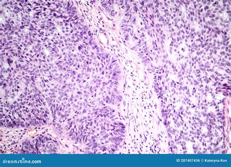 Basal Cell Carcinoma, Light Micrograph Stock Photo - Image of test, cells: 287407436