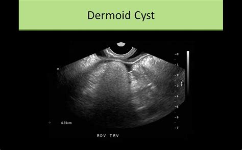 Ovarian Dermoid Cyst Collection Of Ultrasound Images