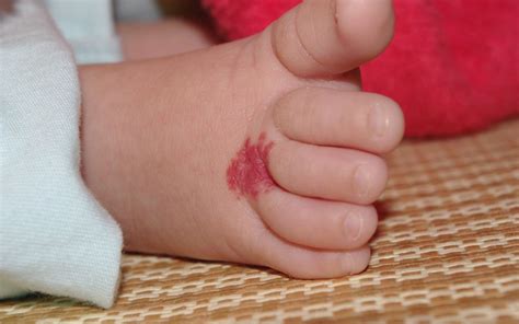 婴儿嘴角血管瘤（孩子胎记的3种说法）-幼儿百科-魔术铺